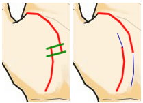 生命線が切れ別の生命線が外側に補佐する 手相の見方ここにあり