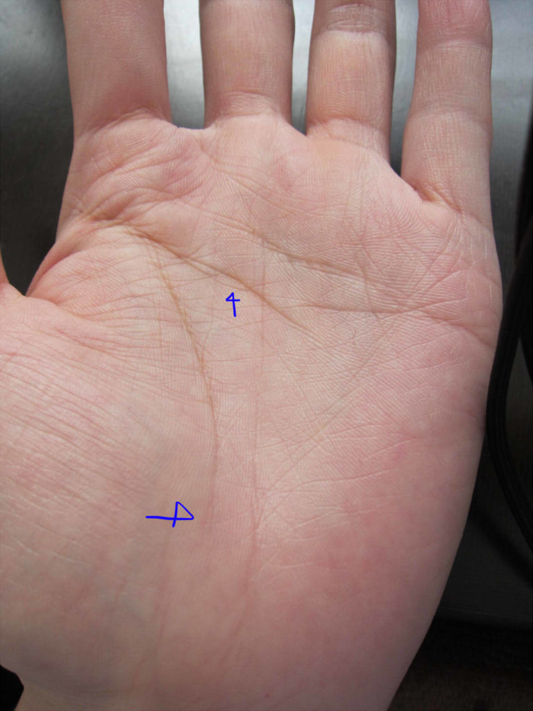 短い生命線と鎖状態の手首線(写真解説)