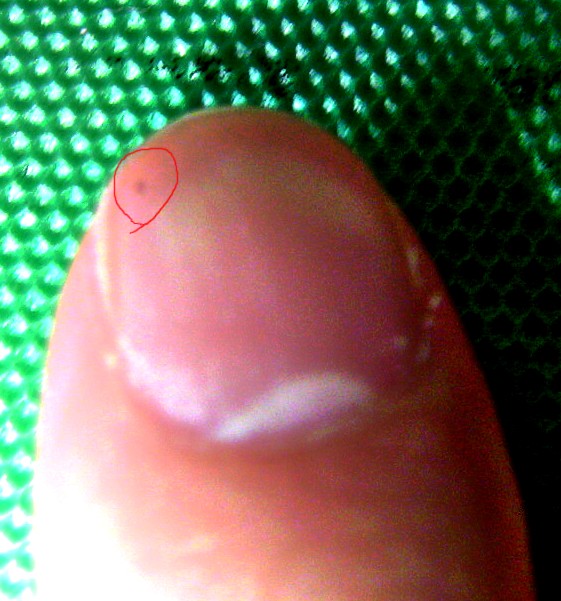 人差し指の爪に生じる黒点・白点