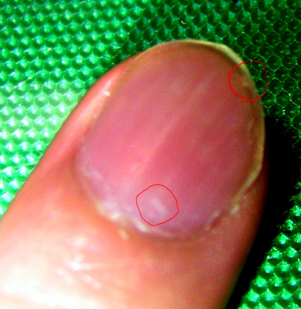 中指の爪に生じる黒点