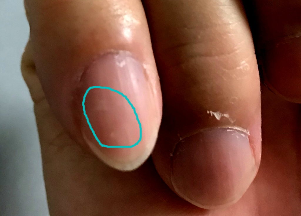 小指の爪に生じる黒点・白点