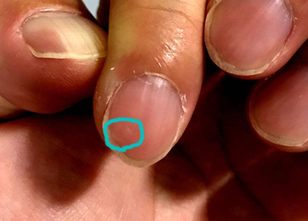 人差し指の爪に生じる黒点・白点